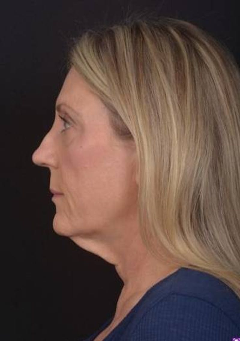 Necklift Before & After Gallery - Patient 312086 - Image 5