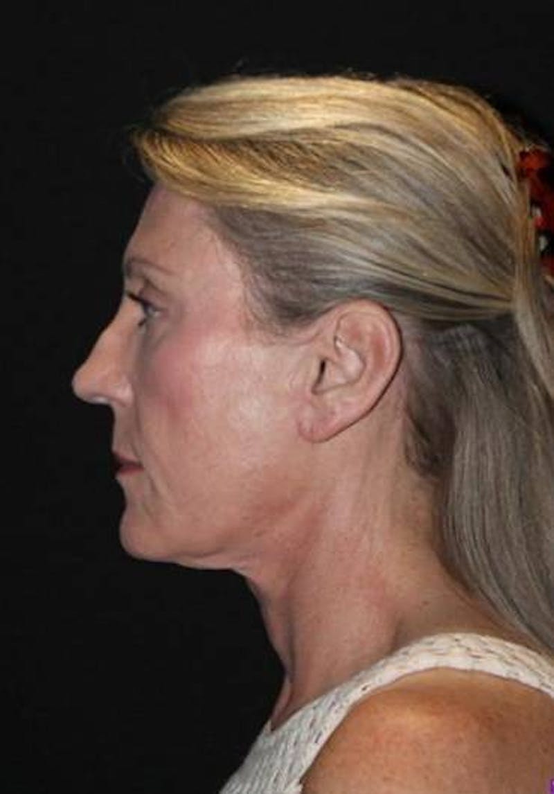 Necklift Before & After Gallery - Patient 312086 - Image 6