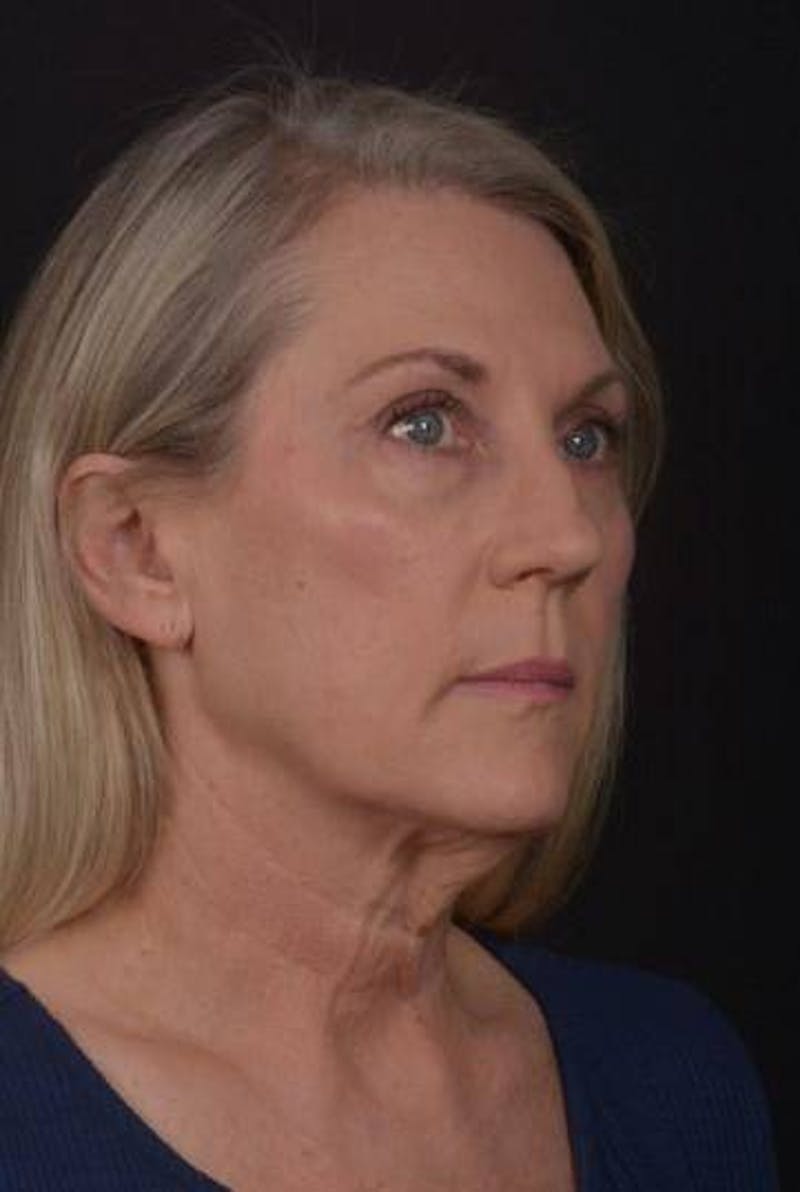 Necklift Before & After Gallery - Patient 312086 - Image 7