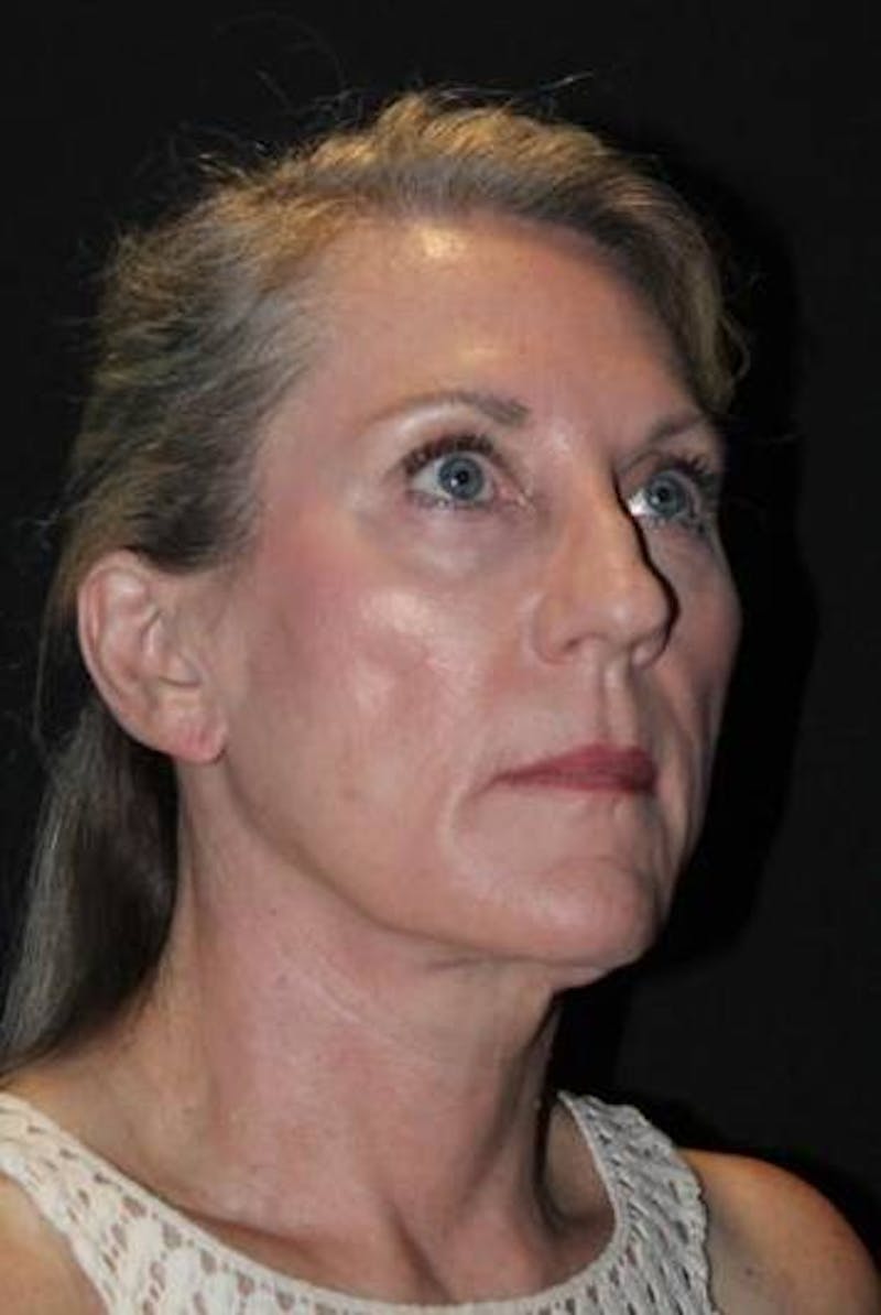 Necklift Before & After Gallery - Patient 312086 - Image 8