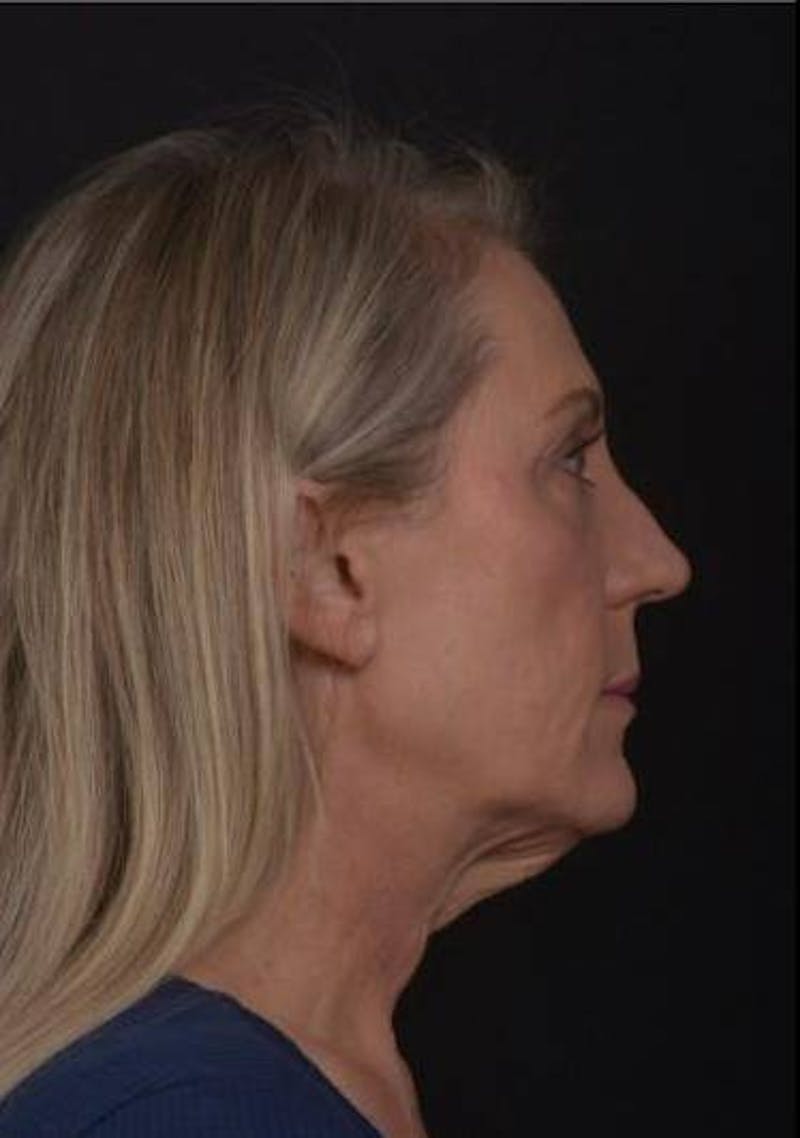 Necklift Before & After Gallery - Patient 312086 - Image 9