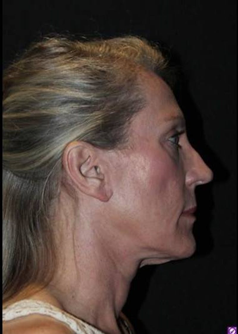 Necklift Before & After Gallery - Patient 312086 - Image 10