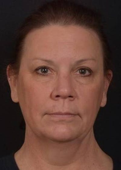 Necklift Before & After Gallery - Patient 374539 - Image 1