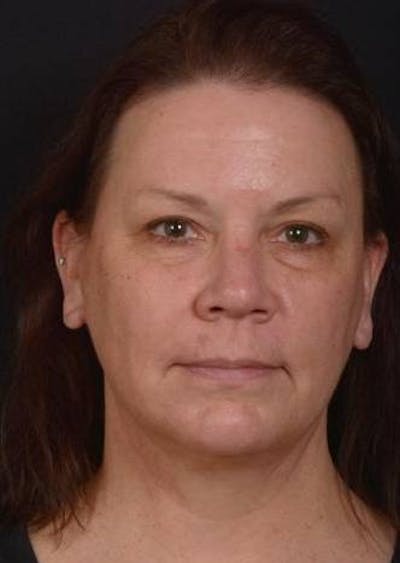 Necklift Before & After Gallery - Patient 374539 - Image 2