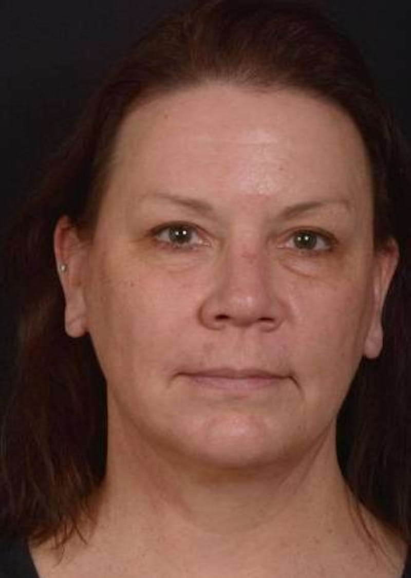 Necklift Before & After Gallery - Patient 374539 - Image 2