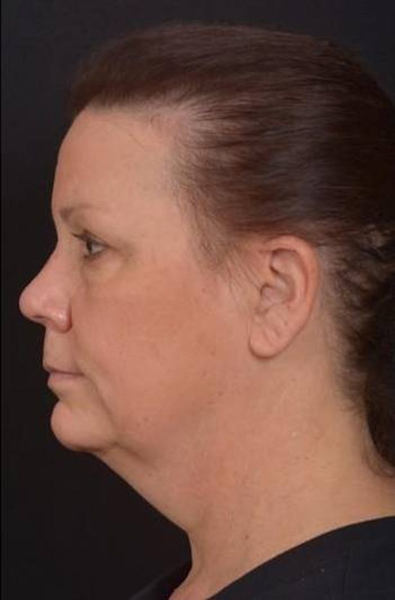 Necklift Before & After Gallery - Patient 374539 - Image 5