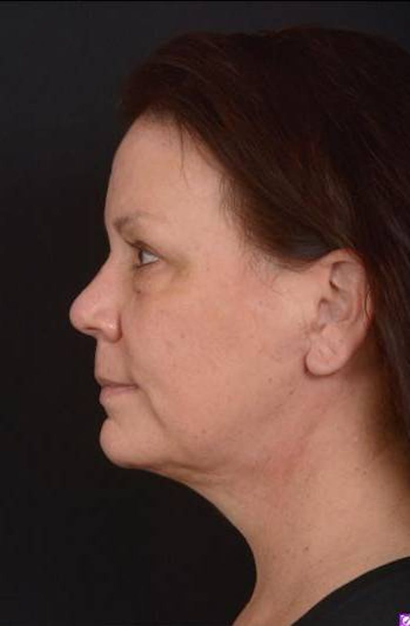 Necklift Before & After Gallery - Patient 374539 - Image 6