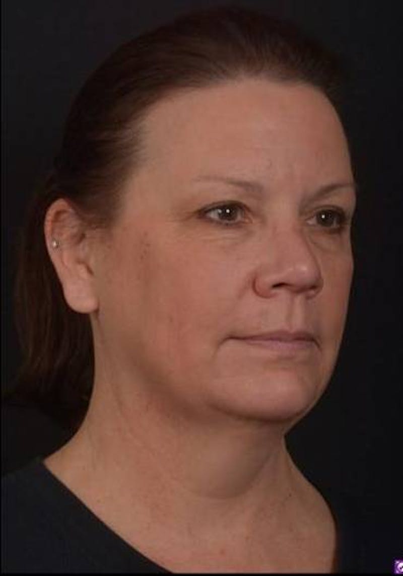 Necklift Before & After Gallery - Patient 374539 - Image 7