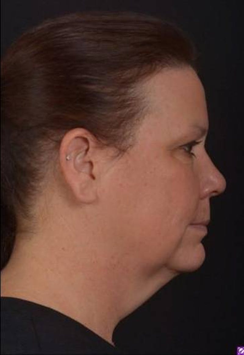 Necklift Before & After Gallery - Patient 374539 - Image 9