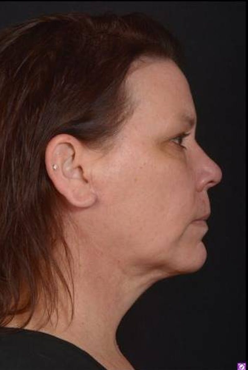 Necklift Before & After Gallery - Patient 374539 - Image 10