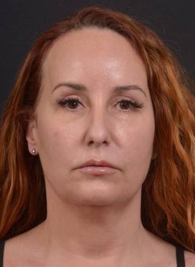 Necklift Before & After Gallery - Patient 204205 - Image 1