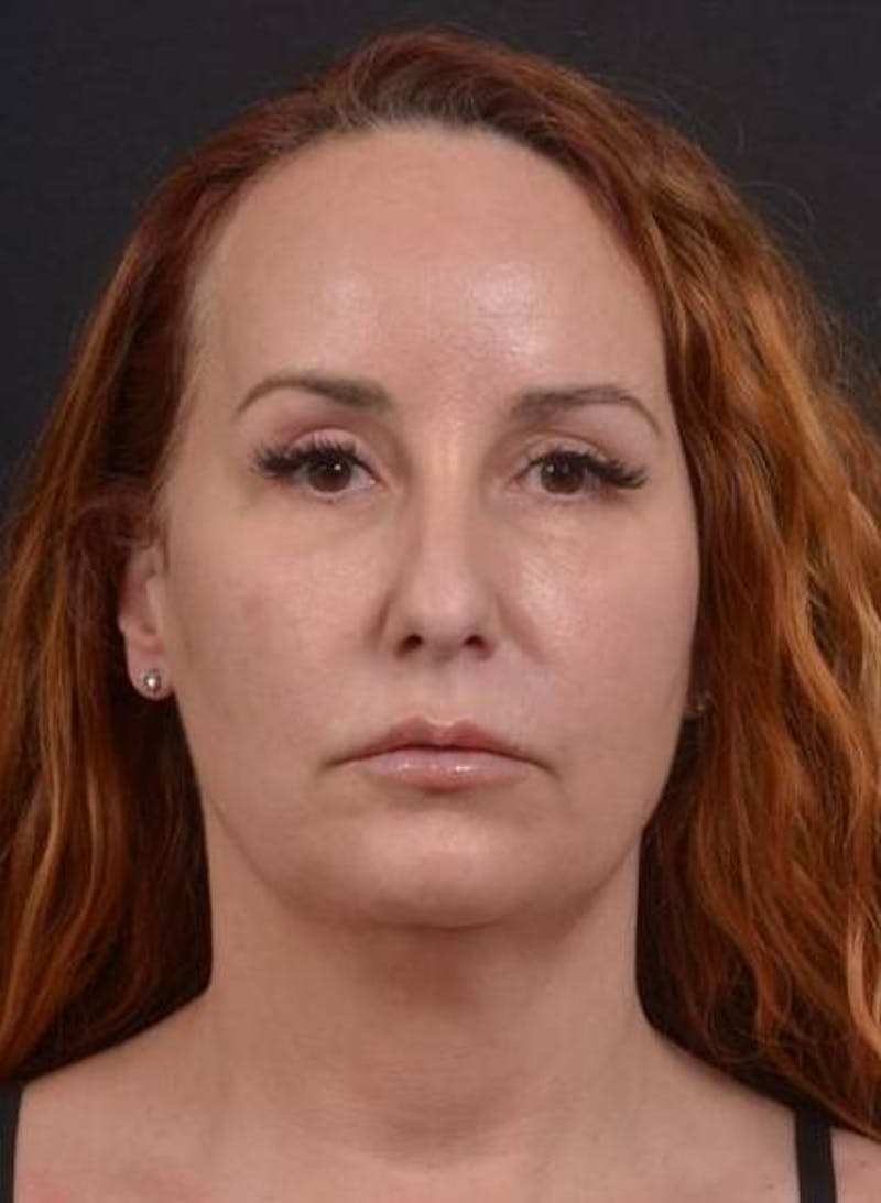 Necklift Before & After Gallery - Patient 204205 - Image 1