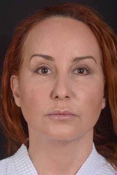 Necklift Before & After Gallery - Patient 204205 - Image 2