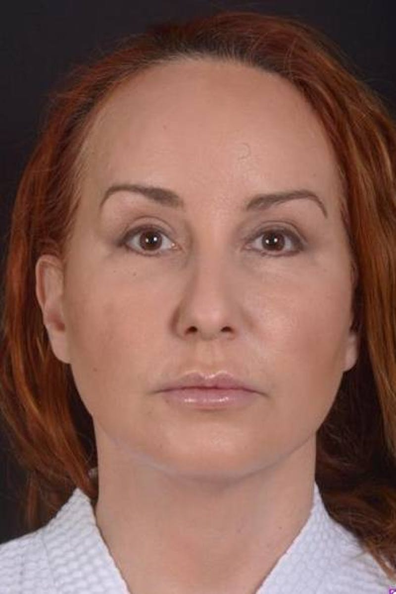 Necklift Before & After Gallery - Patient 204205 - Image 2