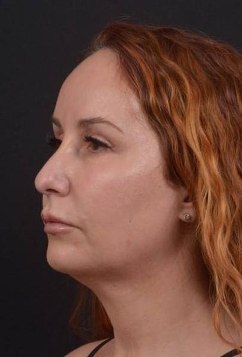 Necklift Before & After Gallery - Patient 204205 - Image 3