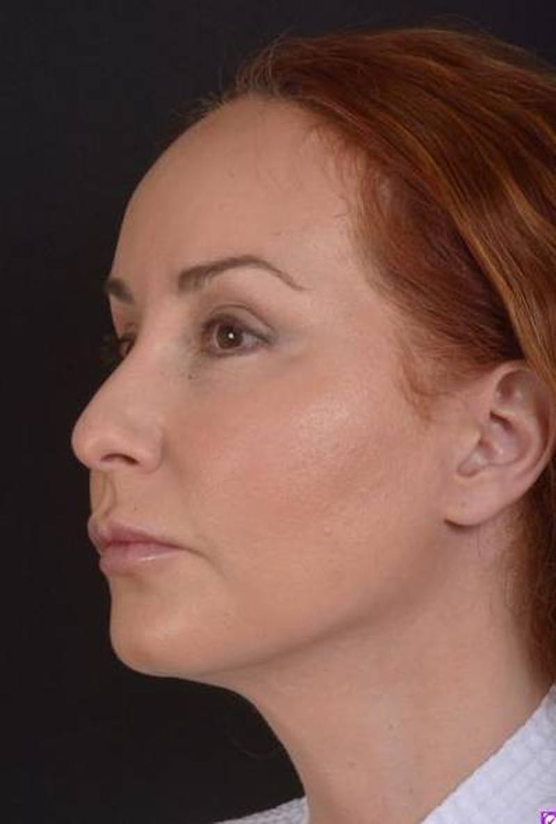 Necklift Before & After Gallery - Patient 204205 - Image 4