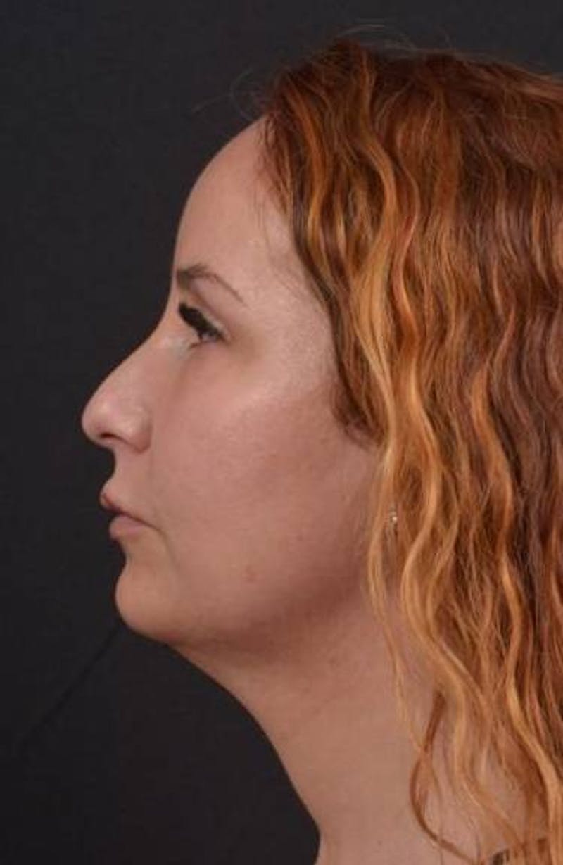 Necklift Before & After Gallery - Patient 204205 - Image 5