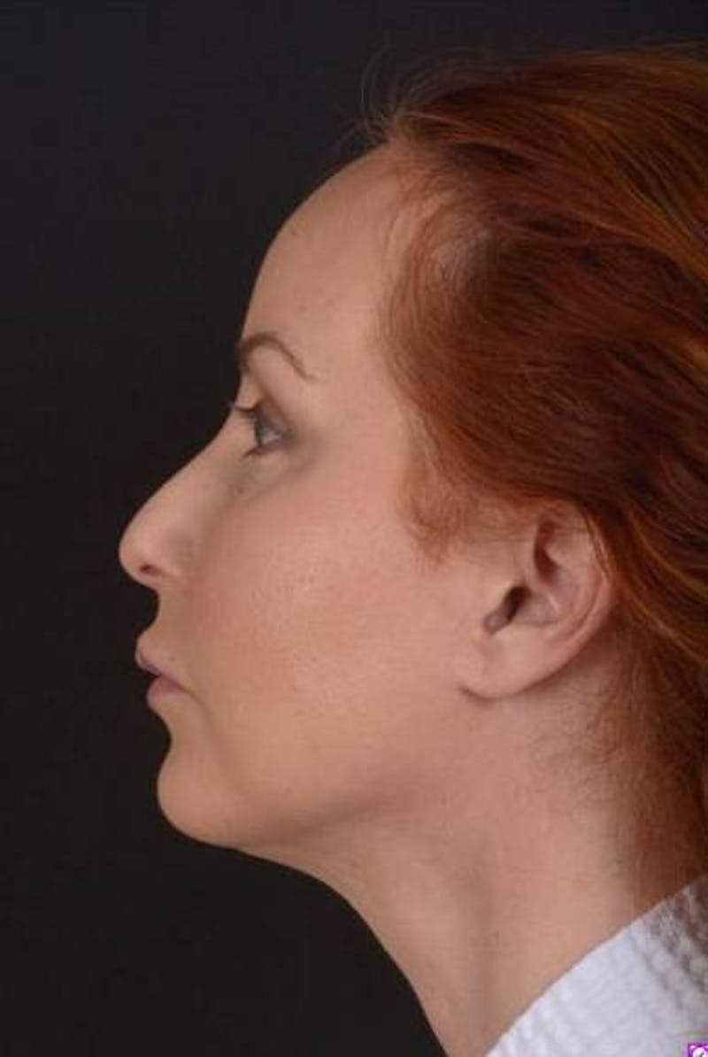 Necklift Before & After Gallery - Patient 204205 - Image 6