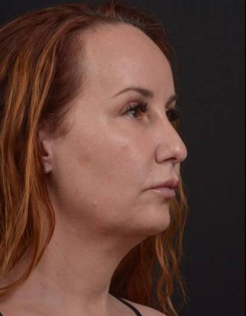Necklift Before & After Gallery - Patient 204205 - Image 7