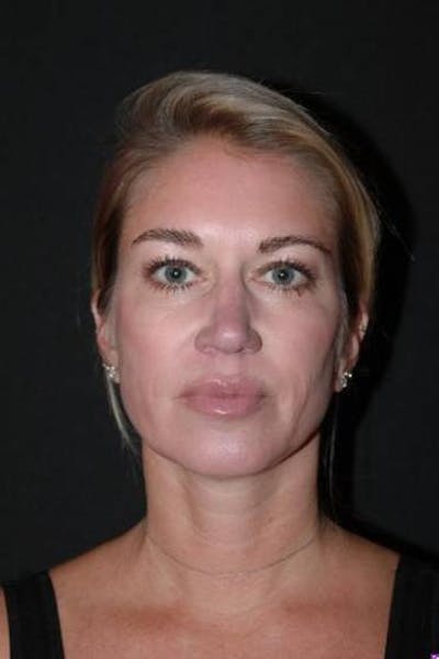 Necklift Before & After Gallery - Patient 128429 - Image 2