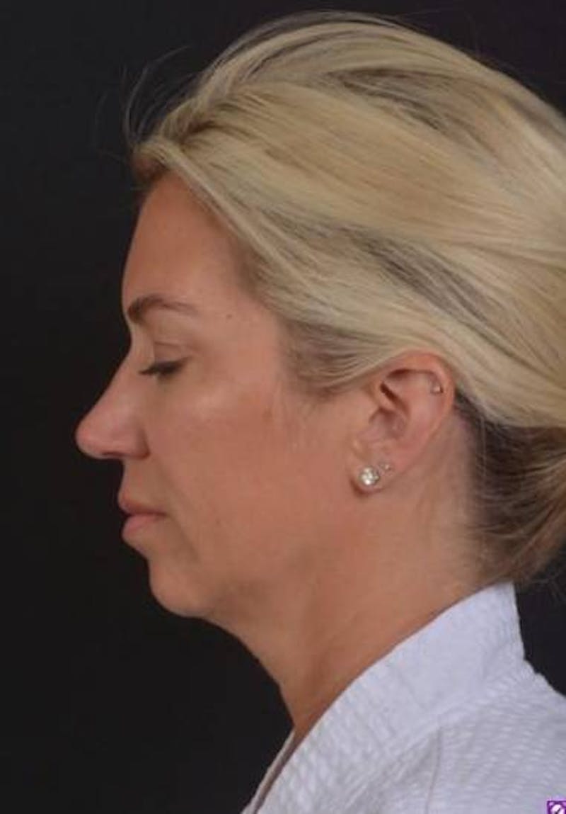 Necklift Before & After Gallery - Patient 128429 - Image 5