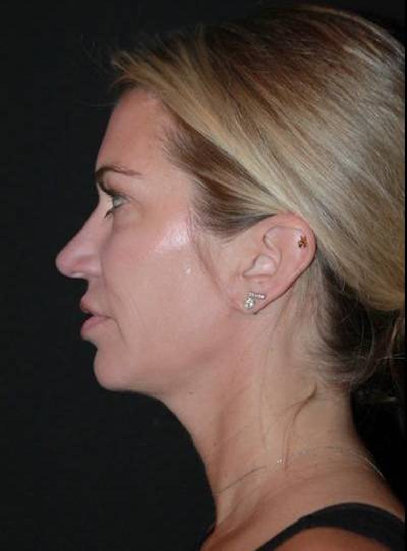 Necklift Before & After Gallery - Patient 128429 - Image 6