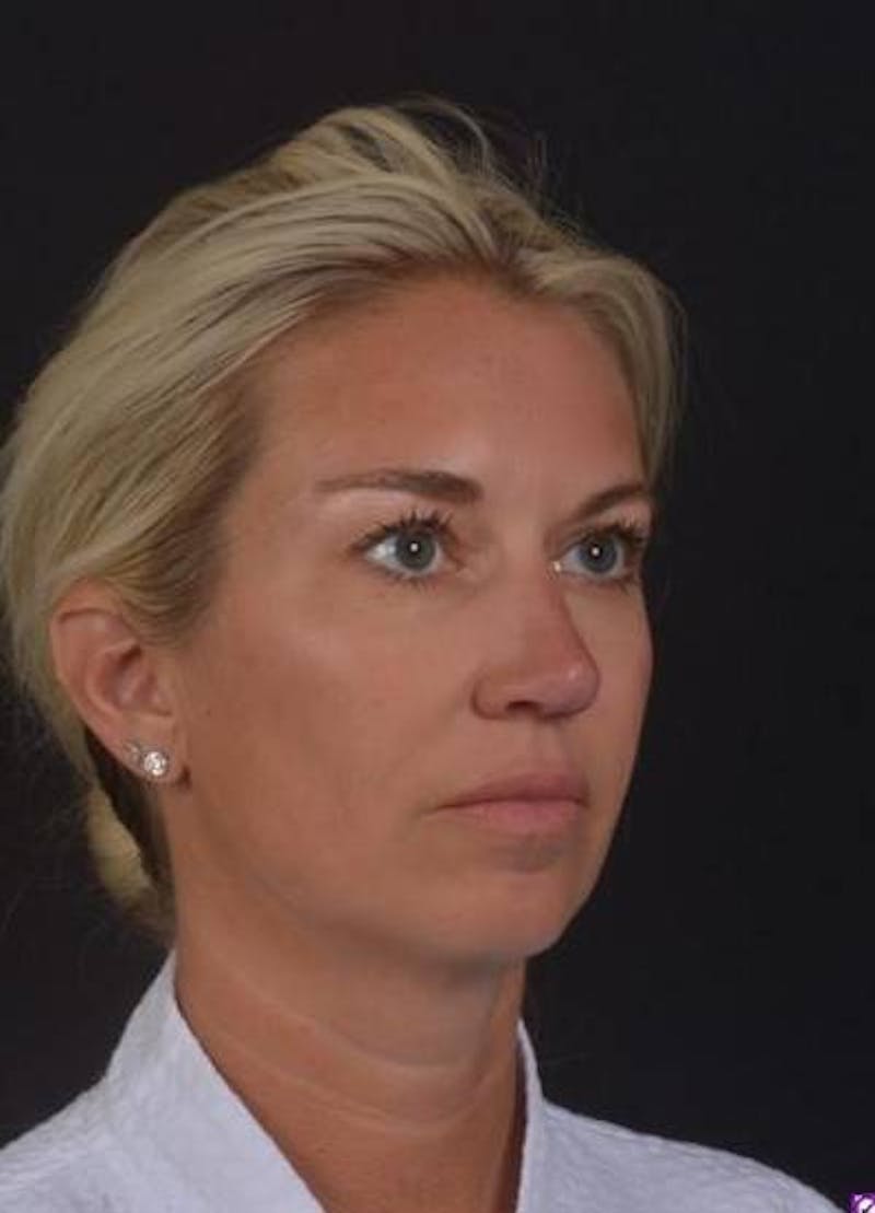 Necklift Before & After Gallery - Patient 128429 - Image 7