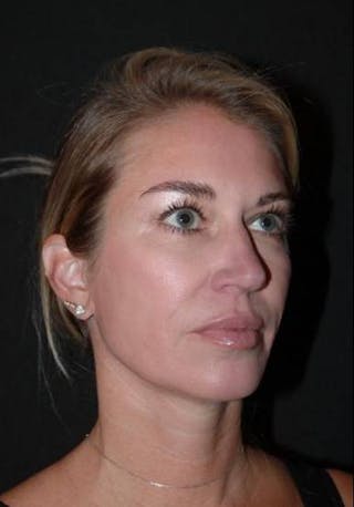 Necklift Before & After Gallery - Patient 128429 - Image 8