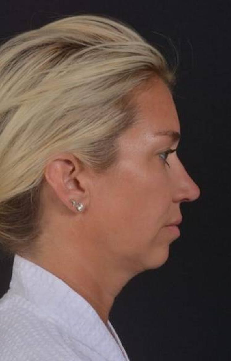Necklift Before & After Gallery - Patient 128429 - Image 9