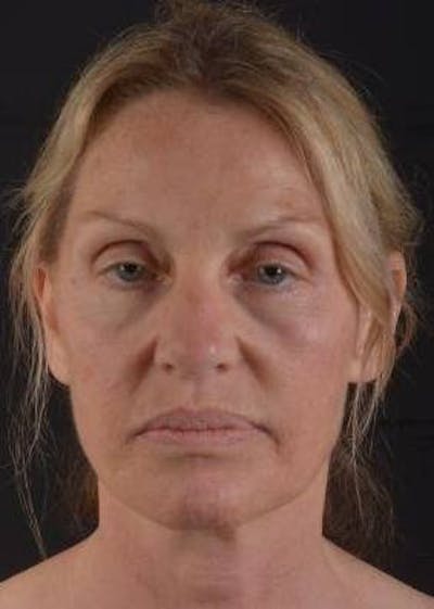 Necklift Before & After Gallery - Patient 300181 - Image 1