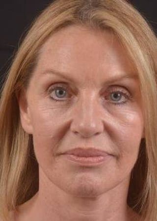 Necklift Before & After Gallery - Patient 300181 - Image 2