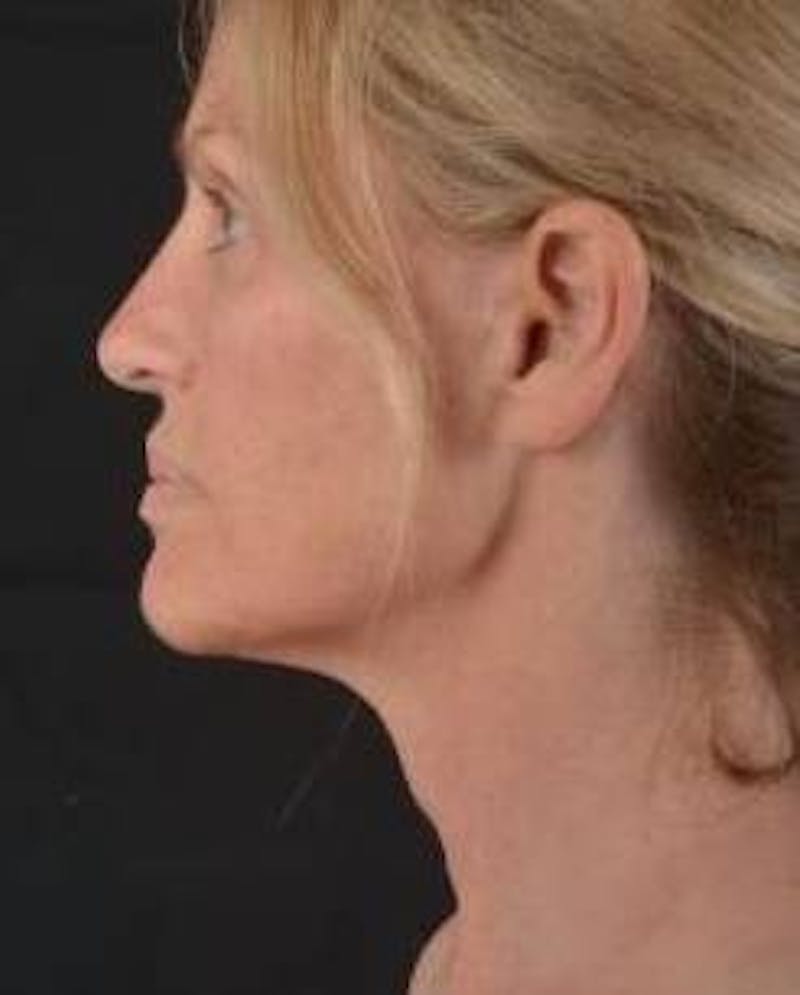 Necklift Before & After Gallery - Patient 300181 - Image 3