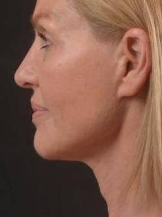 Necklift Before & After Gallery - Patient 300181 - Image 4