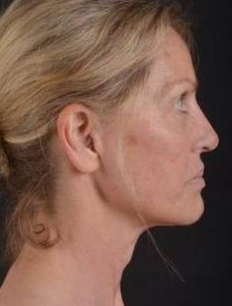 Necklift Before & After Gallery - Patient 300181 - Image 5