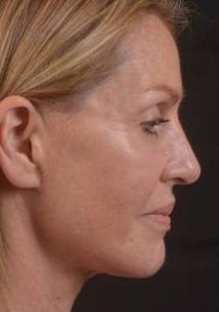 Necklift Before & After Gallery - Patient 300181 - Image 6