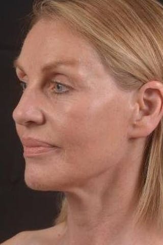 Necklift Before & After Gallery - Patient 300181 - Image 8