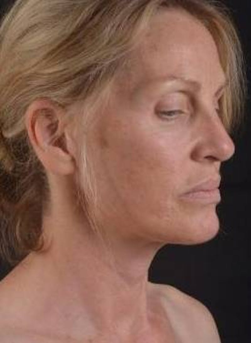 Necklift Before & After Gallery - Patient 300181 - Image 9