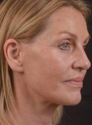 Necklift Before & After Gallery - Patient 300181 - Image 10