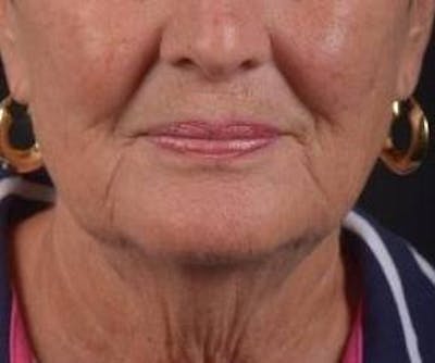 Necklift Before & After Gallery - Patient 192610 - Image 1