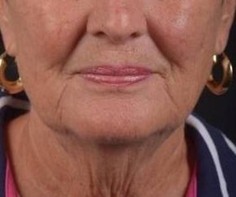 Necklift Before & After Gallery - Patient 192610 - Image 1