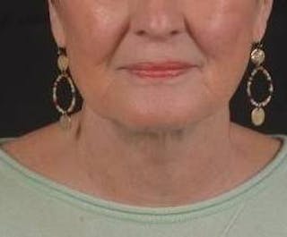 Necklift Before & After Gallery - Patient 192610 - Image 2