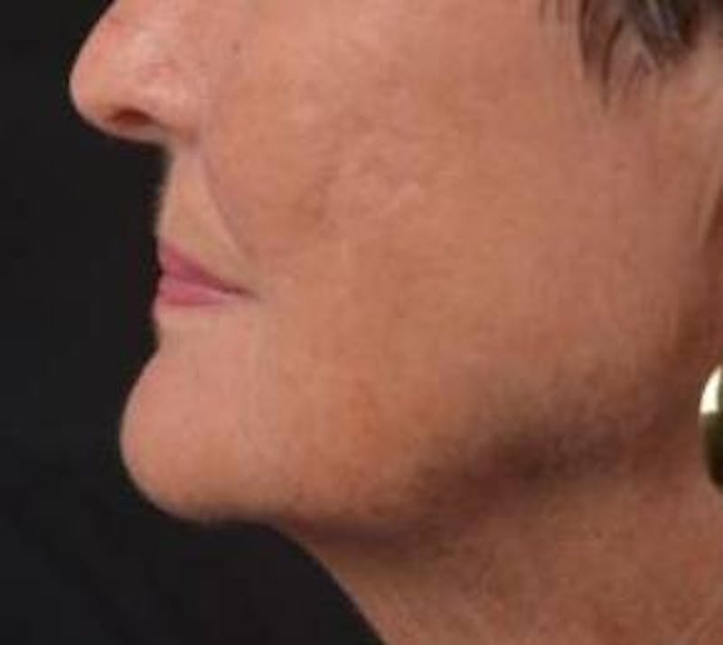 Necklift Before & After Gallery - Patient 192610 - Image 3