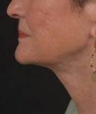Necklift Before & After Gallery - Patient 192610 - Image 4