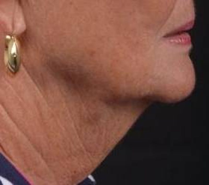 Necklift Before & After Gallery - Patient 192610 - Image 5
