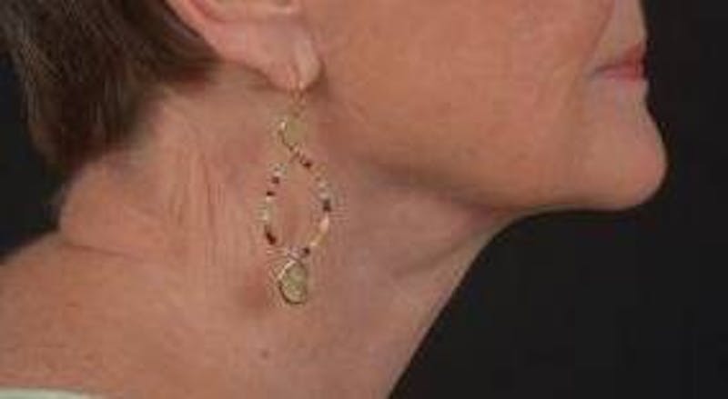 Necklift Before & After Gallery - Patient 192610 - Image 6