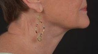 Necklift Before & After Gallery - Patient 192610 - Image 6