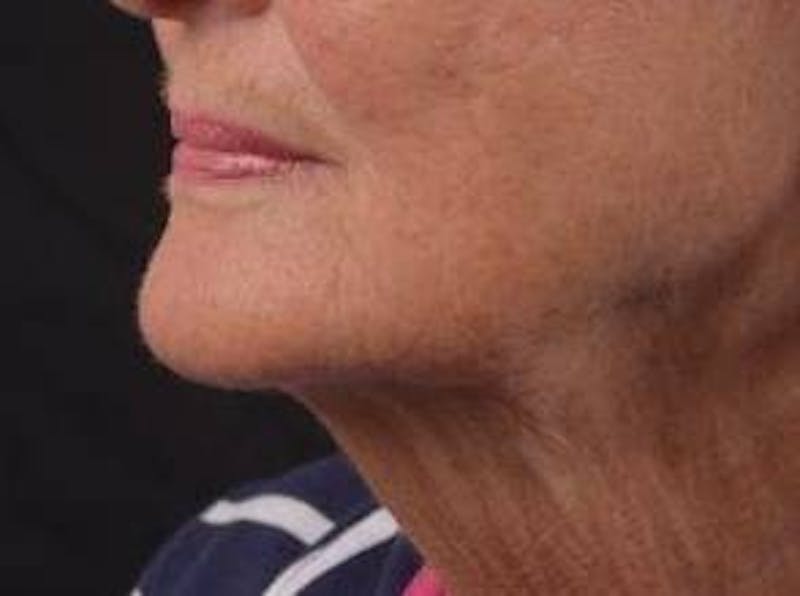 Necklift Before & After Gallery - Patient 192610 - Image 7
