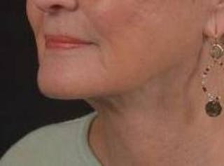Necklift Before & After Gallery - Patient 192610 - Image 8