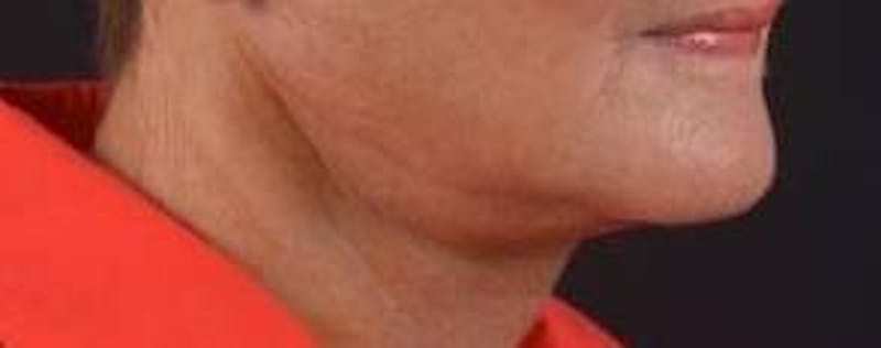 Necklift Before & After Gallery - Patient 192610 - Image 9