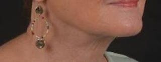 Necklift Before & After Gallery - Patient 192610 - Image 10